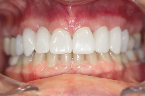 After dental treatment at Oro Valley Dental Arts - Case 1