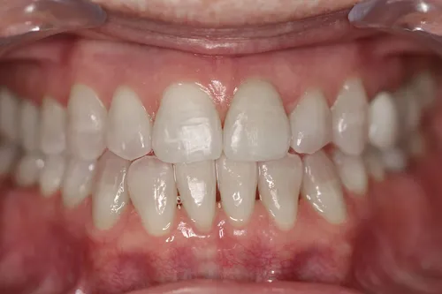 After dental treatment at Oro Valley Dental Arts - Case 2