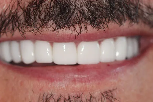 After dental treatment at Oro Valley Dental Arts - Case 3