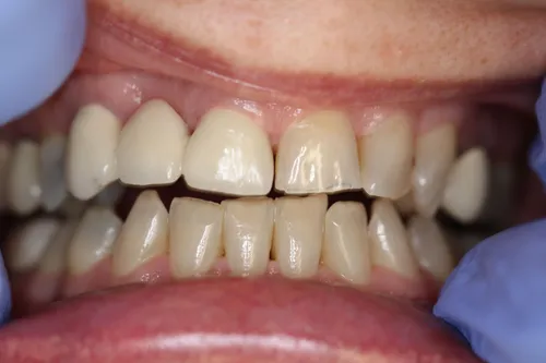 Before dental treatment at Oro Valley Dental Arts - Case 1