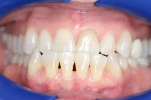 Before dental treatment at Oro Valley Dental Arts - Case 2